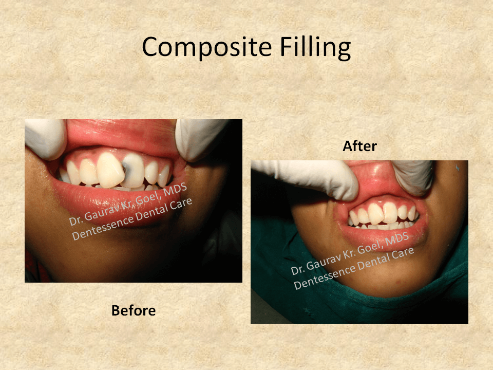 Anterior tooth Fracture Composite Dentessence Dental Care, Best Dental Clinic in Noida