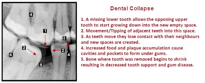 Xray showing consequences of missing tooth.