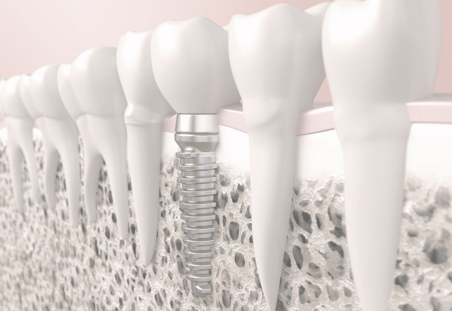 Best centre for Dental Implant noida