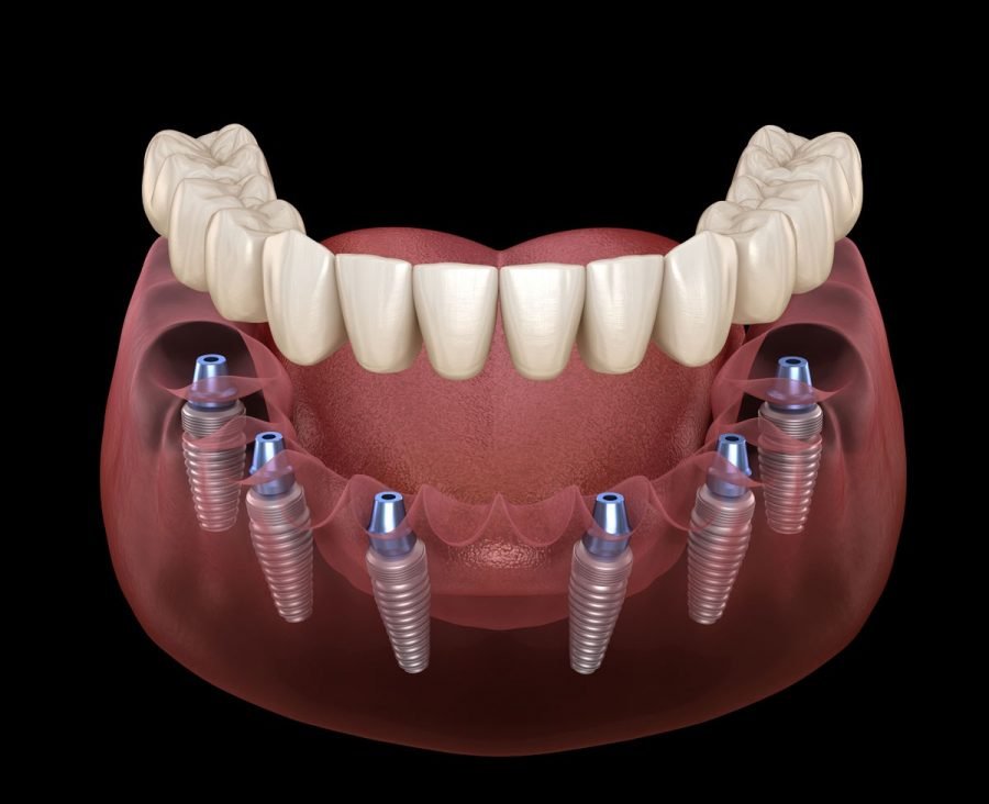 All-on-6 dental Implants