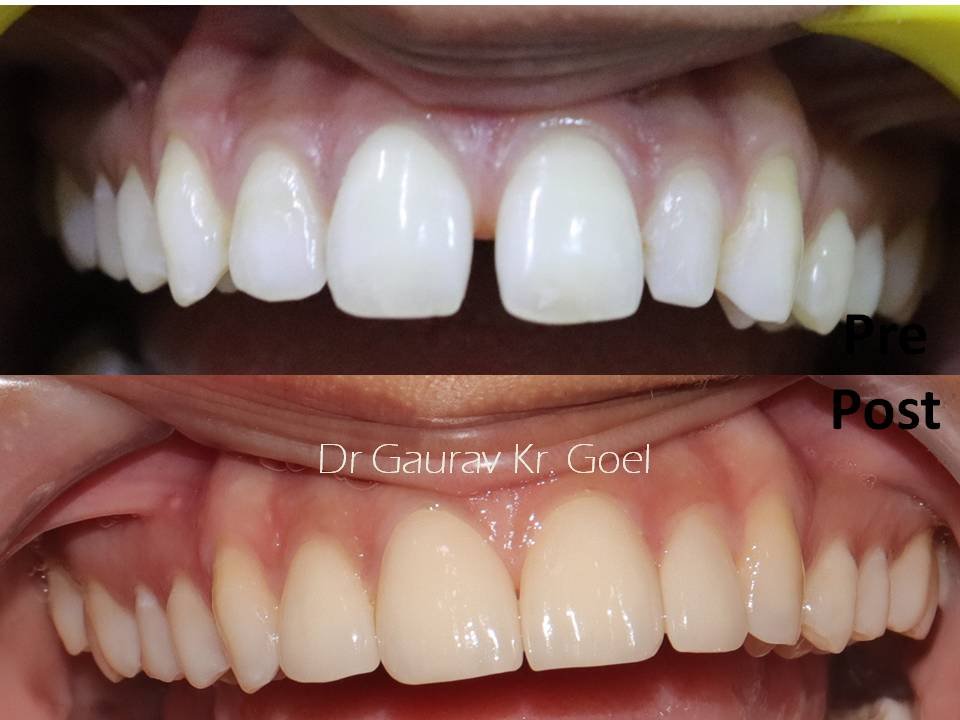 Ceramic Veneers laminates emax before and after picture dr gaurav kumar goel dentessence noida